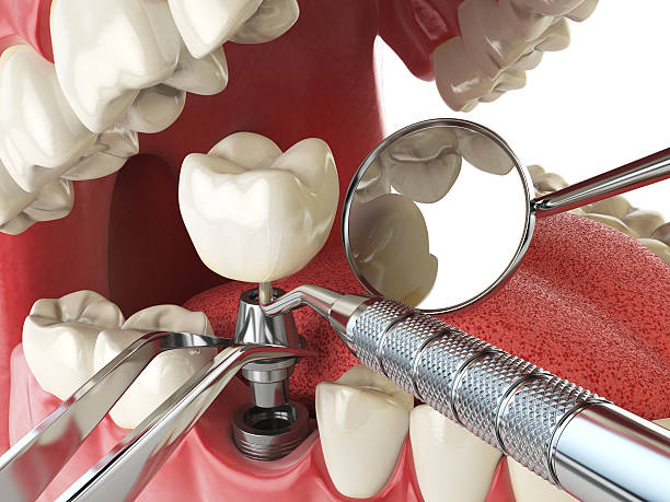 Best Urgent Care for Lost Fillings or Crowns in Union Gap, WA